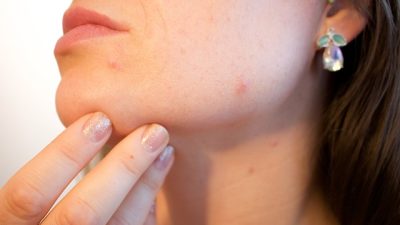 Cara Menghilangkan Noda Hitam Bekas Jerawat Dalam 1 Malam: Begini Caranya Mudah dan Simpel